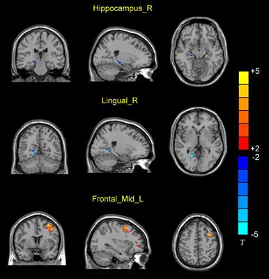 Neural Dysconnectivity in the Hippocampus Correlates With White Matter Lesions and Cognitive Measures in Patients With Coronary Artery Disease